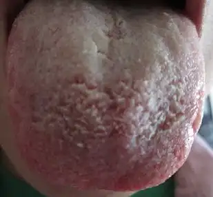 舌苔发白 一个多月了 吃药不见好 本人女23岁 求助 急 附图