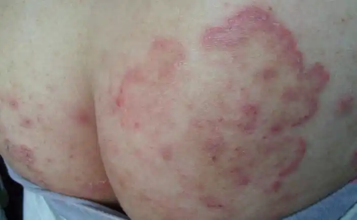 股癣是什么?有图片吗?