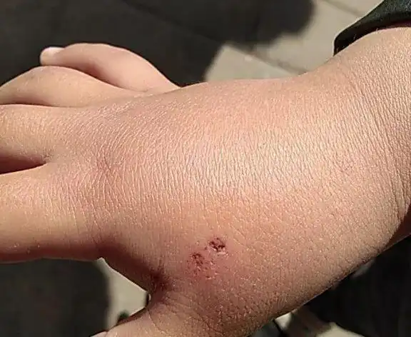 滨州5岁娃被老鼠咬伤急寻出血热疫苗!市疾控中心这样说