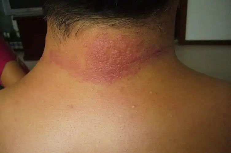 日光过敏?不能晒太阳!