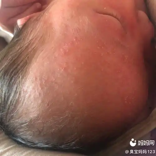 新生儿痤疮