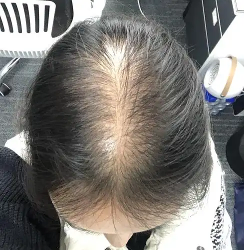 脂溢性脱发治疗记录更新对比图