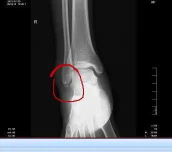 小孩踝关节x光片正常