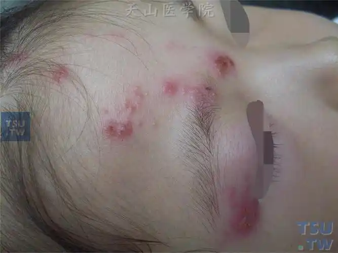 带状疱疹(herpes zoster)症状表现