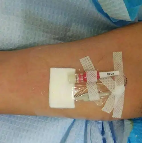 静脉治疗化疗患者的福音全程一针治疗picc置管术帮你办