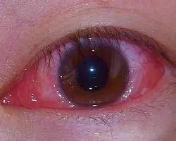 小儿患结膜炎的防治措施儿童细菌性结膜炎的治疗措施