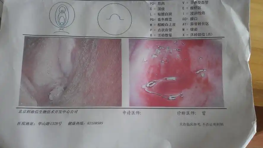 这个到底是息肉还是湿疣?我抠掉了.出了血 一点点疼而已.