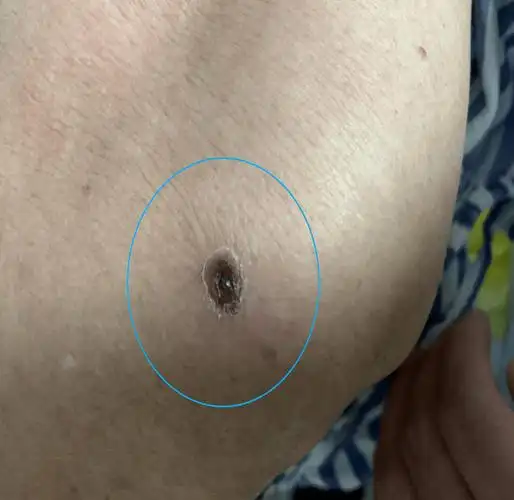 夏日警惕"恙虫病"_患者_环境_传播