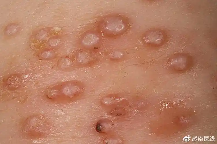 这种"水瘊子"新疗法非常高效,安全,简便