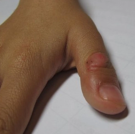 大拇指关节骨质增生治疗