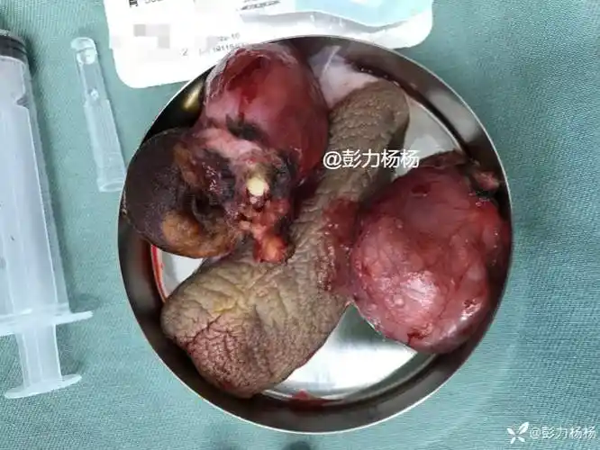 病例分享男科终极手术21岁男生带医嘱要求切除双侧睾丸如果你是医生做