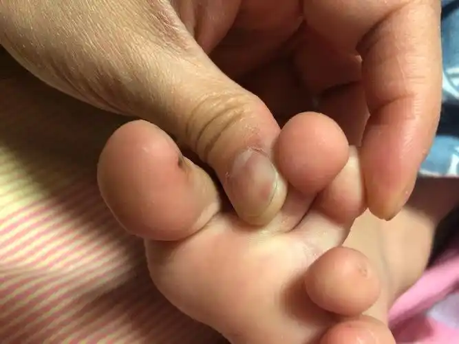 孩子晚上会闹着脚痒仔细看脚趾和前脚掌有红点十个脚趾肚几户