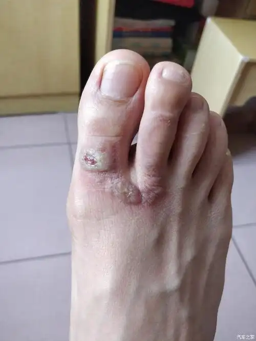 锋驭爆暖风水箱之烫伤脚系列