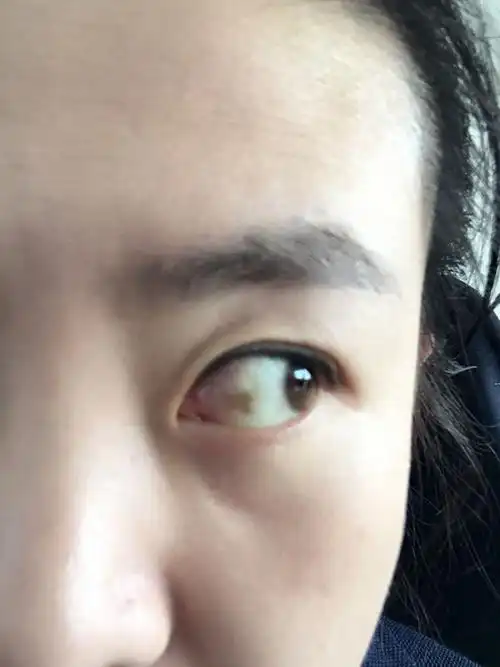 请问眼角内有黄斑,这可以做手术么?做手术后对眼睛有什么影响么?