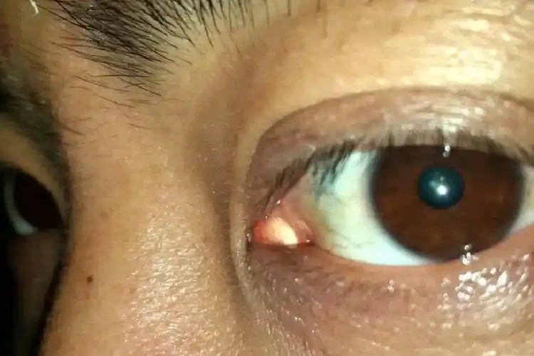 泪阜不正常的图片