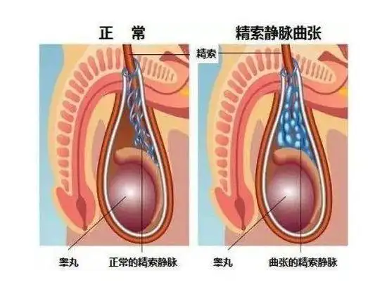 精索曲张睾丸下坠时图片 (41)