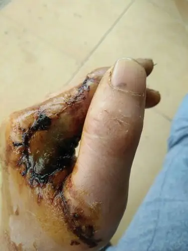 有什么办法能更快长处新皮.谢谢大家给点意见