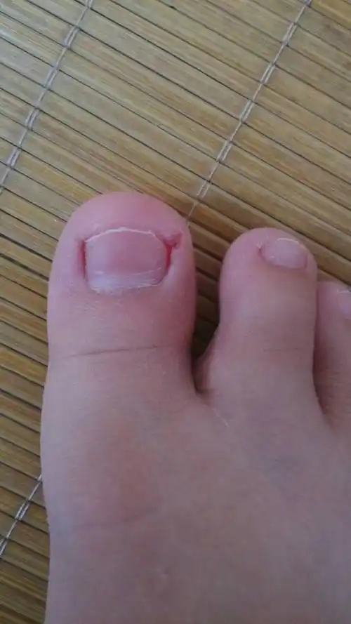 这个情况的甲沟炎怎么办