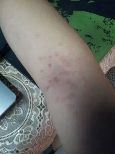 最近手臂上长了些这种斑,请问是啥?如何解决