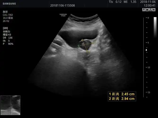超声图像显示于膀胱壁可见一偏低回声肿物,形态规则,边界清,cdfi示内