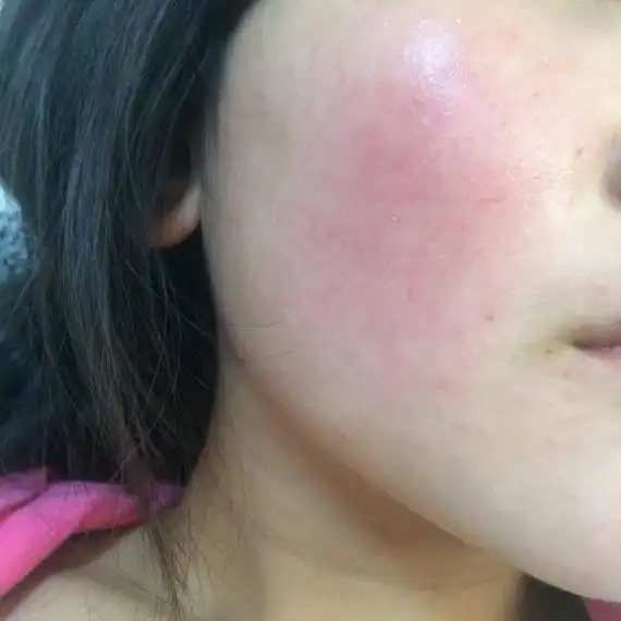 脸永远都是红红的红血丝还好不怎么明显