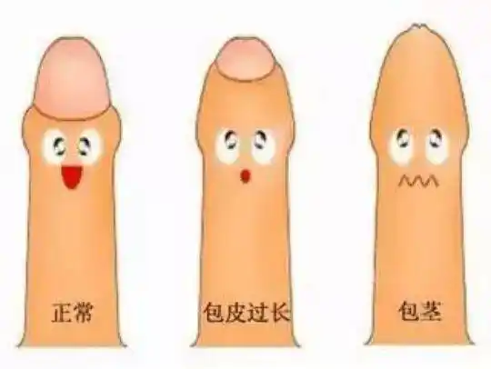 包皮过长不够凉爽?悄悄告诉你小丁丁的那点事儿