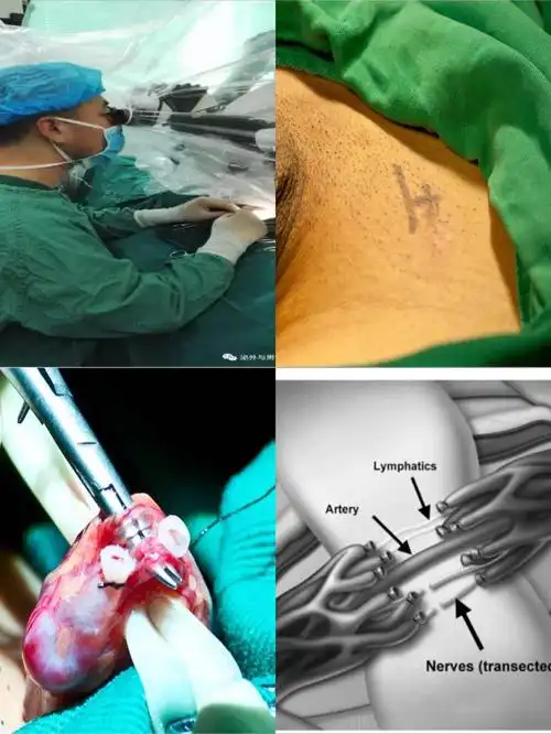 精索静脉曲张的诊治科普