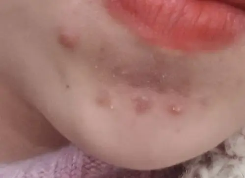 姨妈已经迟了几天了下巴也长了好多痘