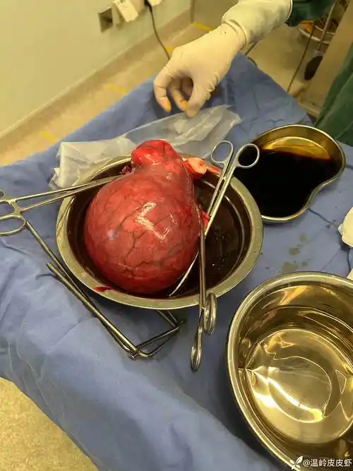 病例分享好久没见到这么大的子宫肌瘤了