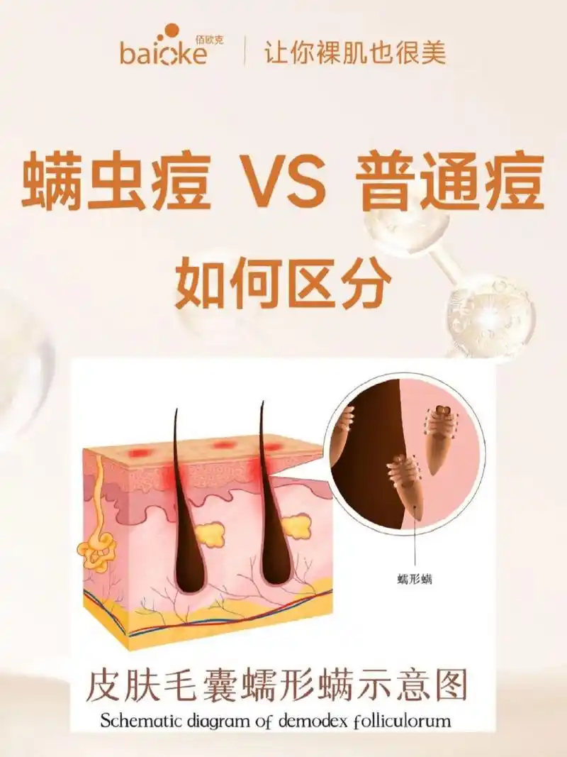 螨虫痘 vs 普通痘 | 如何区分这两种痘96 关于螨虫 螨虫有40多种