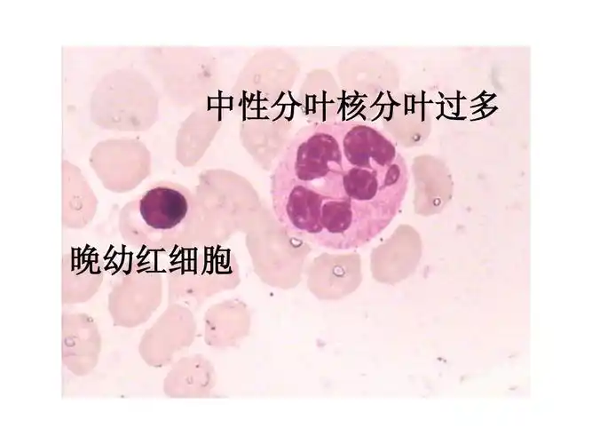 实验诊断学 中性分叶核分叶过多 晚幼红细胞