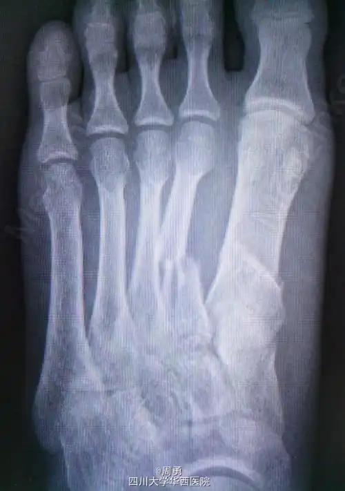 左足第1,2跖骨中近1/3骨折闭合复位克氏针内固定术