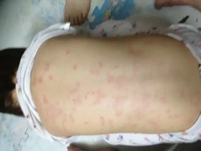 宝宝荨麻疹|小儿荨麻疹|慢性荨麻疹|宝宝|月嫂