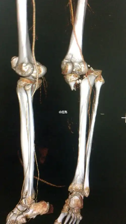 胫骨平台粉碎性骨折关节脱位ct三维重建视频