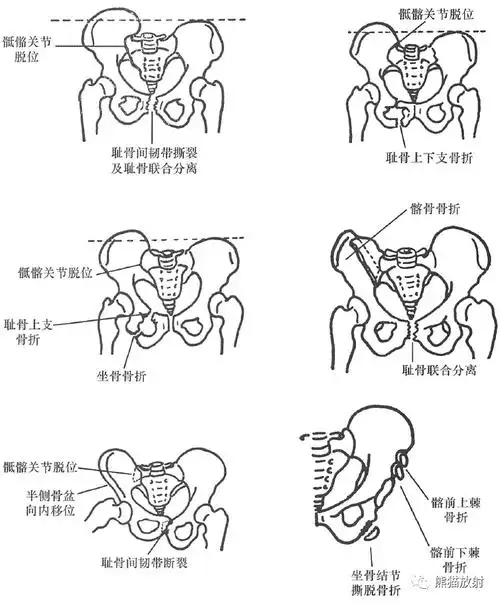 骨盆及下肢骨折的分类