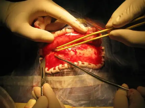 开颅手术不可怕