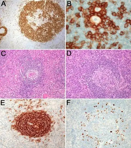 图3:igd显示生发中心进行性转化(a);结节性淋巴细胞为主型霍奇金淋巴