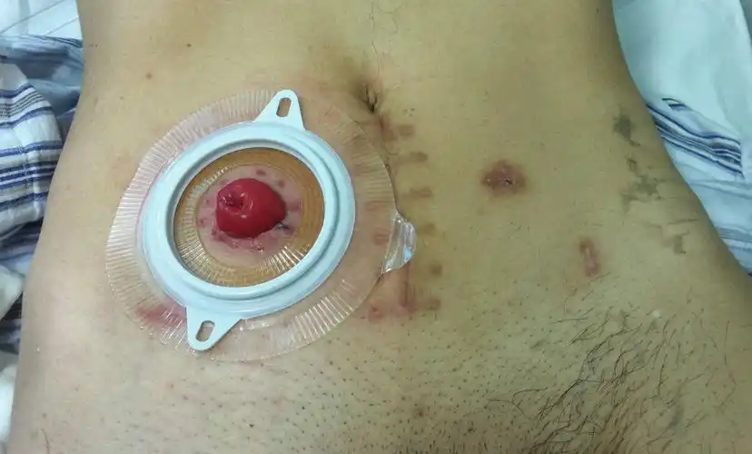 腹腔镜膀胱癌根治术