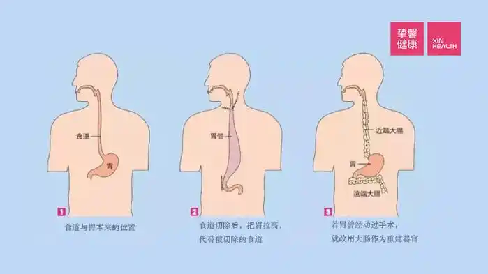 全面了解食管癌手术是怎样的