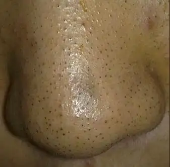 教你轻松去除烦人的黑头!