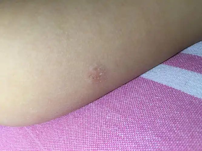 十五个月幼儿腿部出现皮藓样症状害怕是牛皮癣求儿科大夫诊断