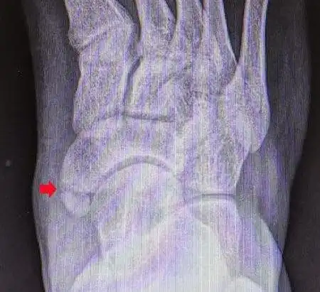 足内侧突出(副舟骨损伤)_踝部扭伤_症状表现_检查_治疗方式 - 好大夫