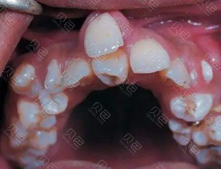 昆明小孩牙齿矫正多少钱群里宝妈说很贵大概要10000元