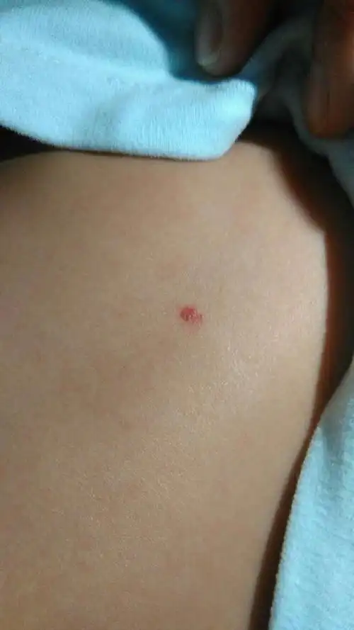 血管瘤激光多少钱