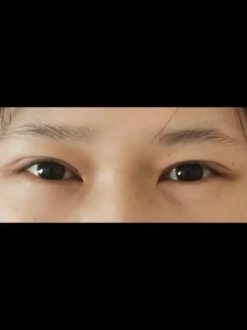 但右眼比左眼宽,尾部上挑多一_圈子-新氧美容整形