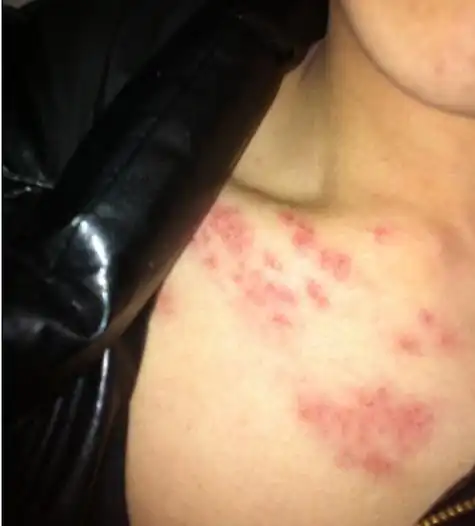 女性艾滋病感染者图片