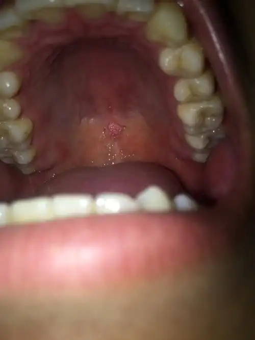 口腔长肉球,不疼不痒