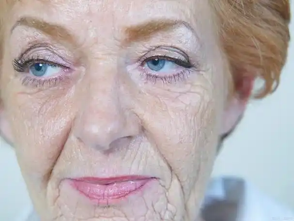 面部哪些地方容易滋生皱纹?多为什么原因造成的?