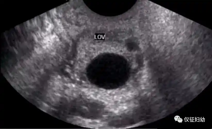 科普经阴道b超监测排卵不可不知的细节