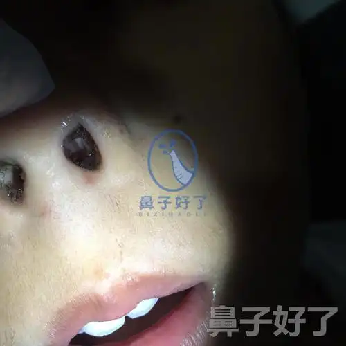 小朋友身患鼻炎7年饱受折磨鼻子好了治愈鼻炎